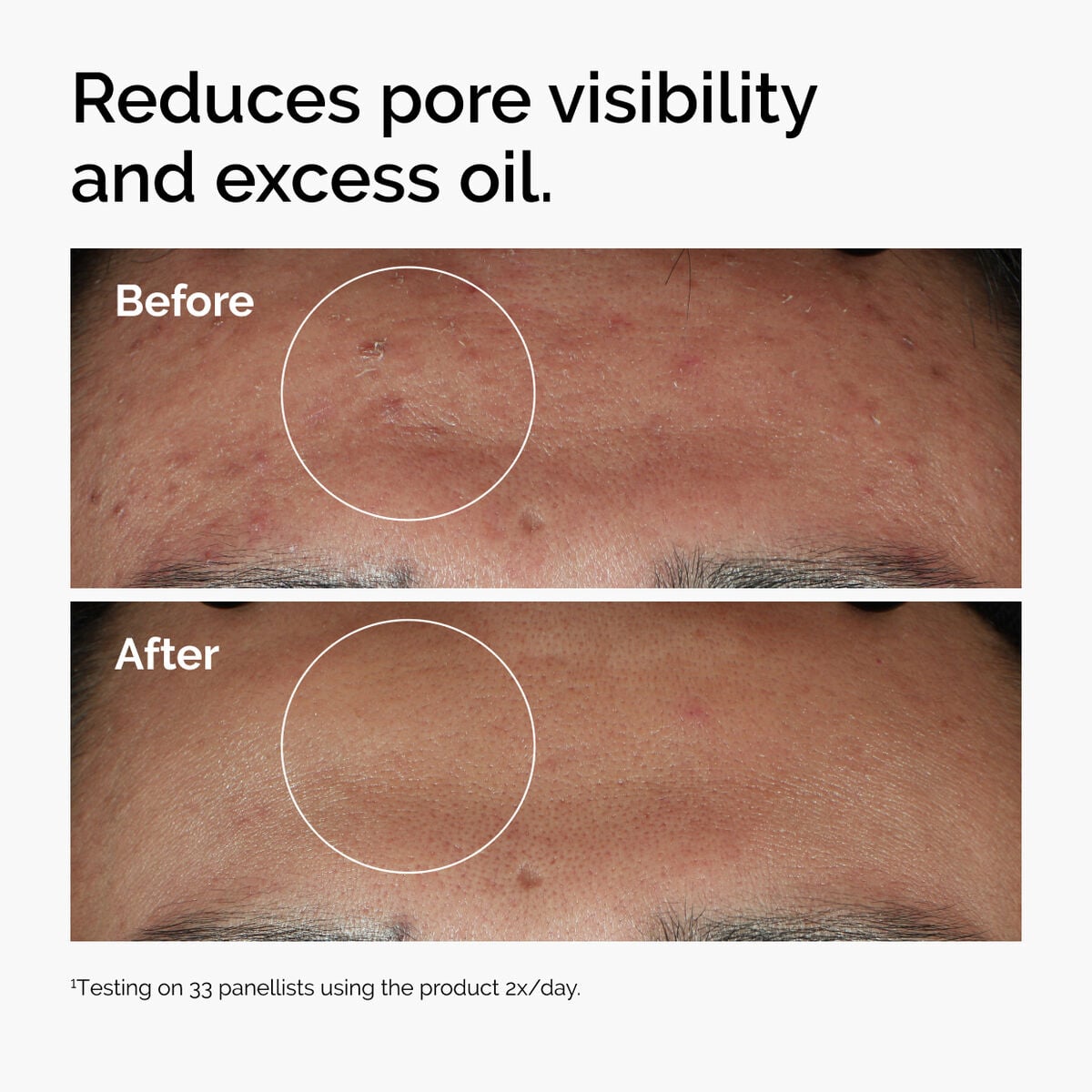 niacinamide-10-zinc-1-v3 ord-niacinamide-zinc-blemish-serum-before-after-pores.jpg