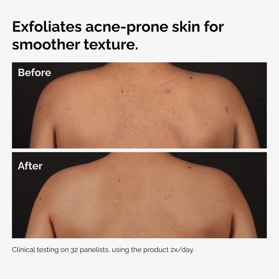 the-body-care-collection-q5 ord-salicylic-acid-body-serum-before-after-graphic-NA.jpg