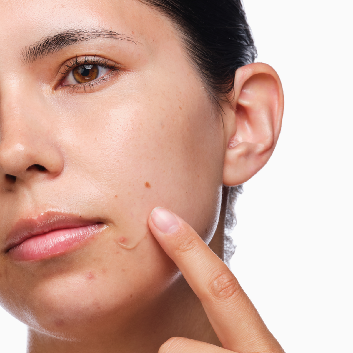the-acne-set-u6 rdn-the-acne-set-application.png